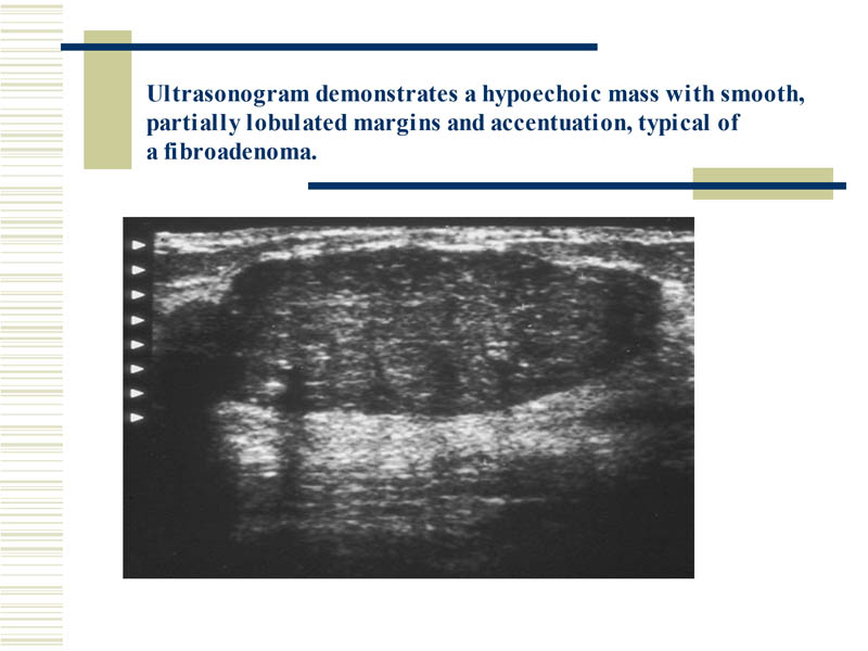 breast ultrasonogram typical of fibroadenoma